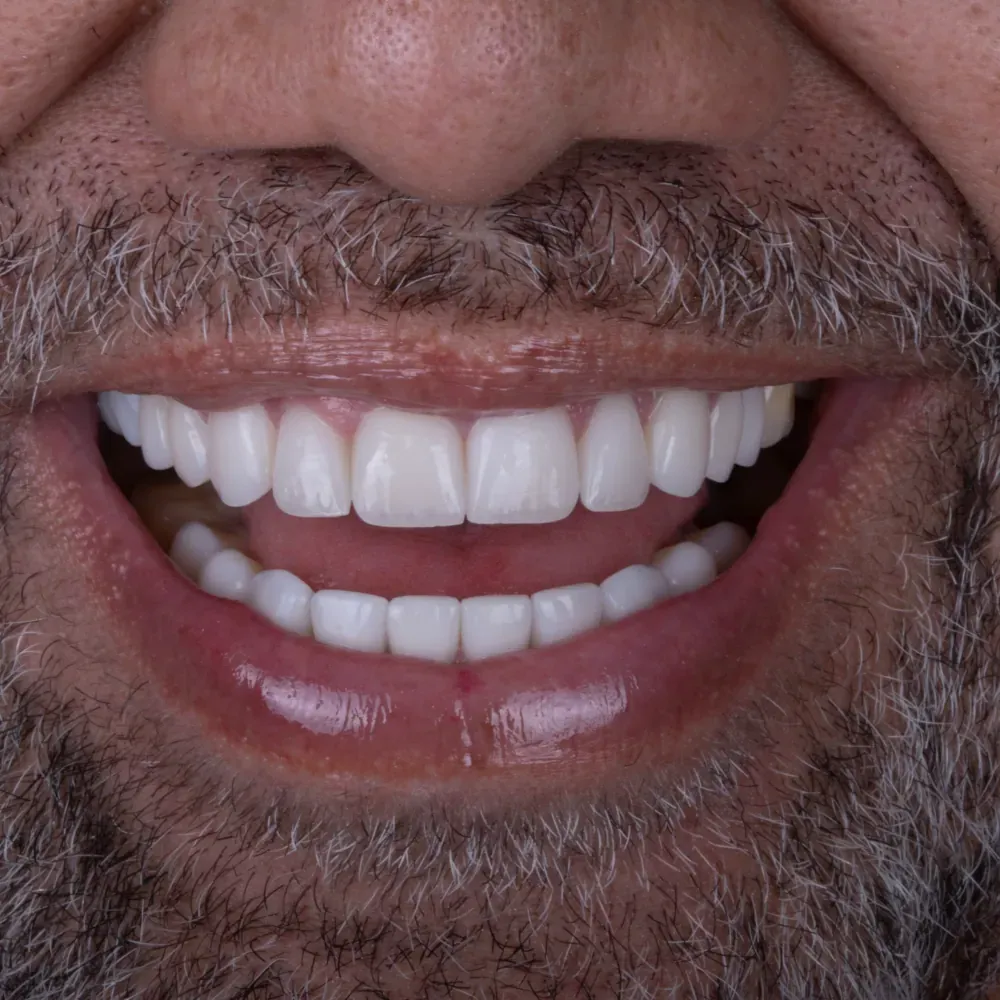 Close-up of a smile restored with Smile Forever polyresin veneers