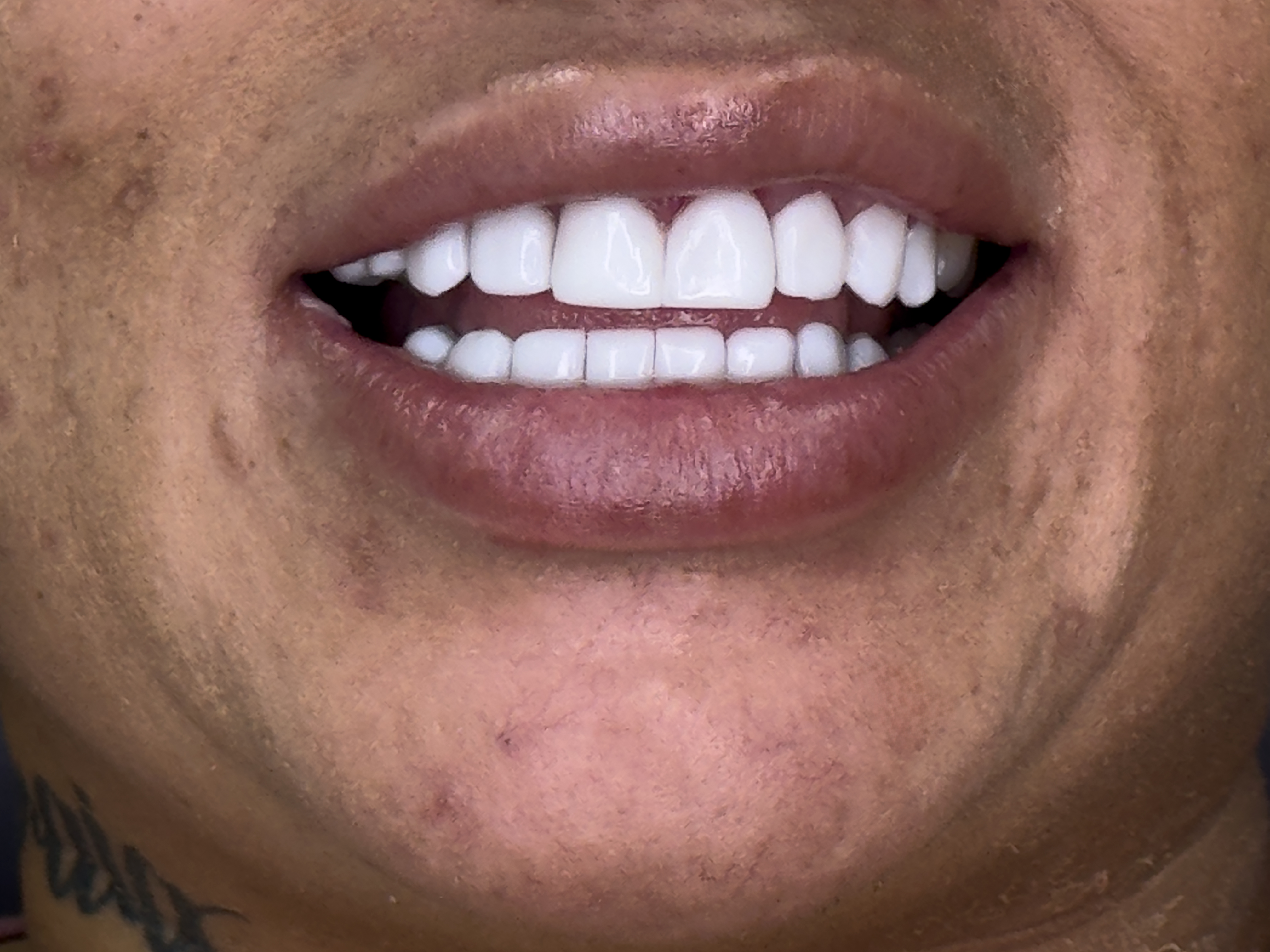 Smile with Smile Forever resin