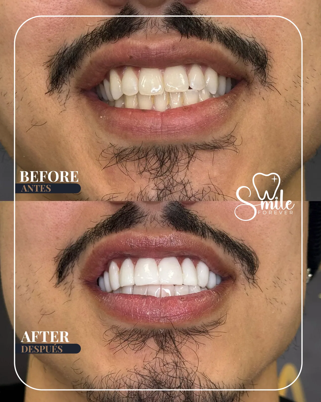 Before and after: resin design