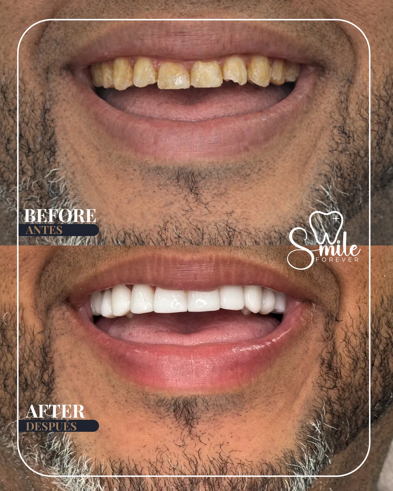Before and after: resin, natural result