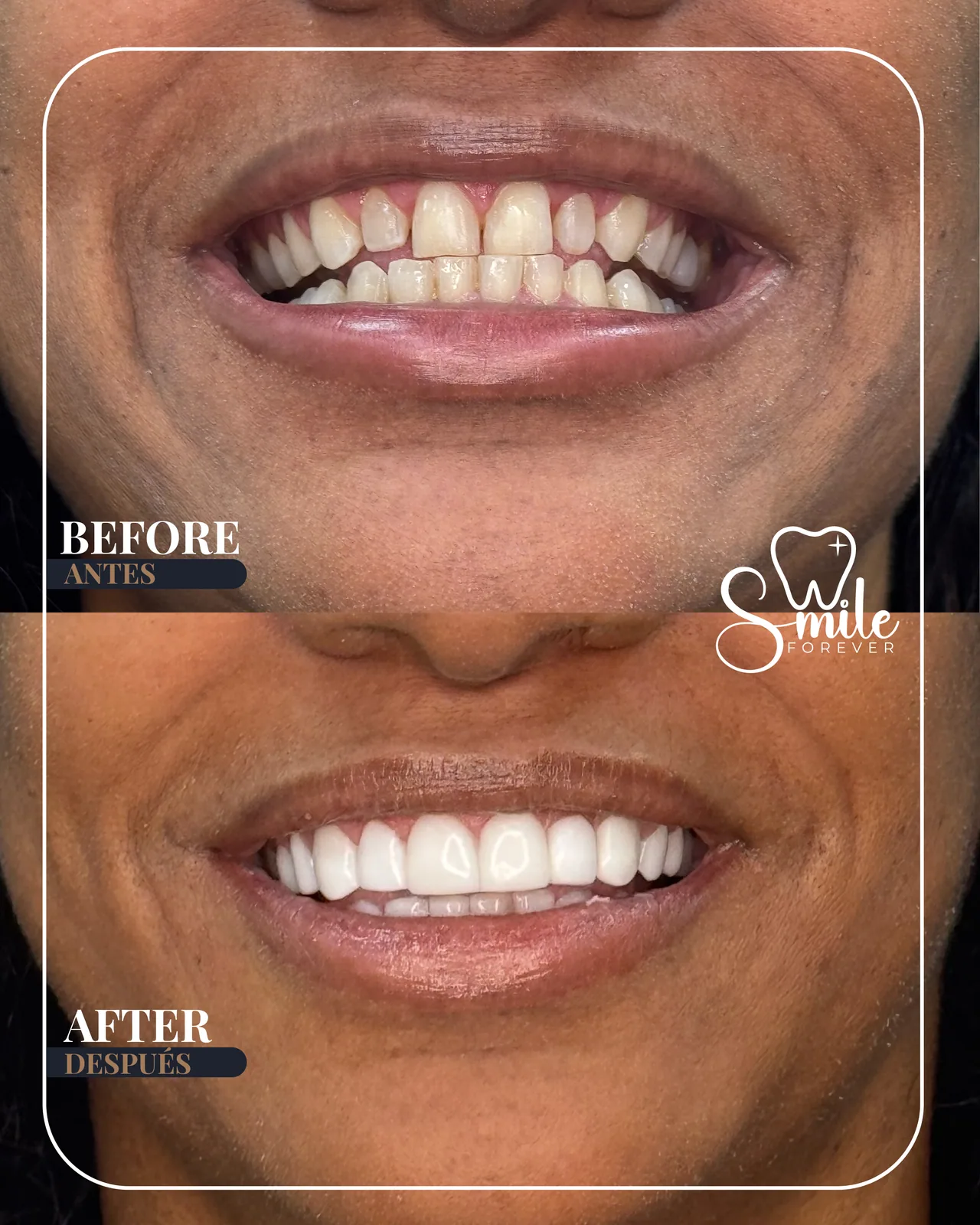 Before and after: diastema closure with polyresin