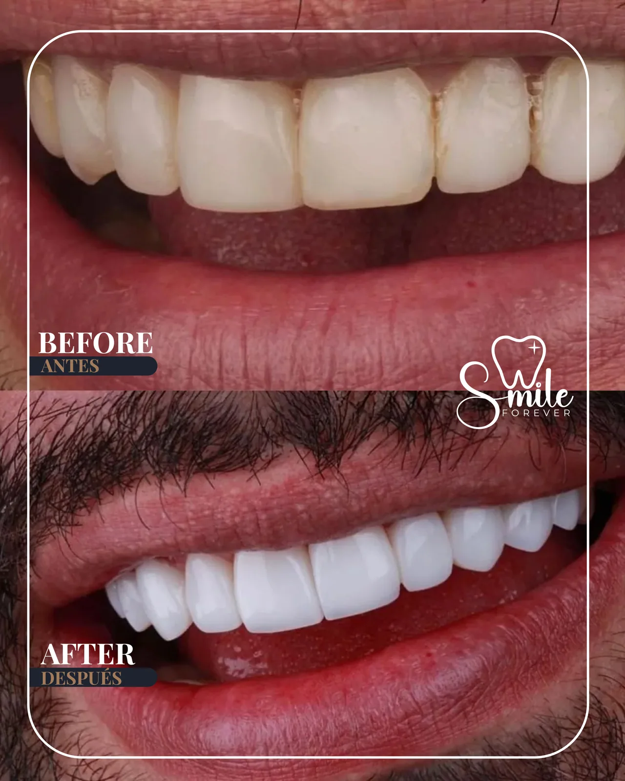 Before and after with premium Smile Forever porcelain