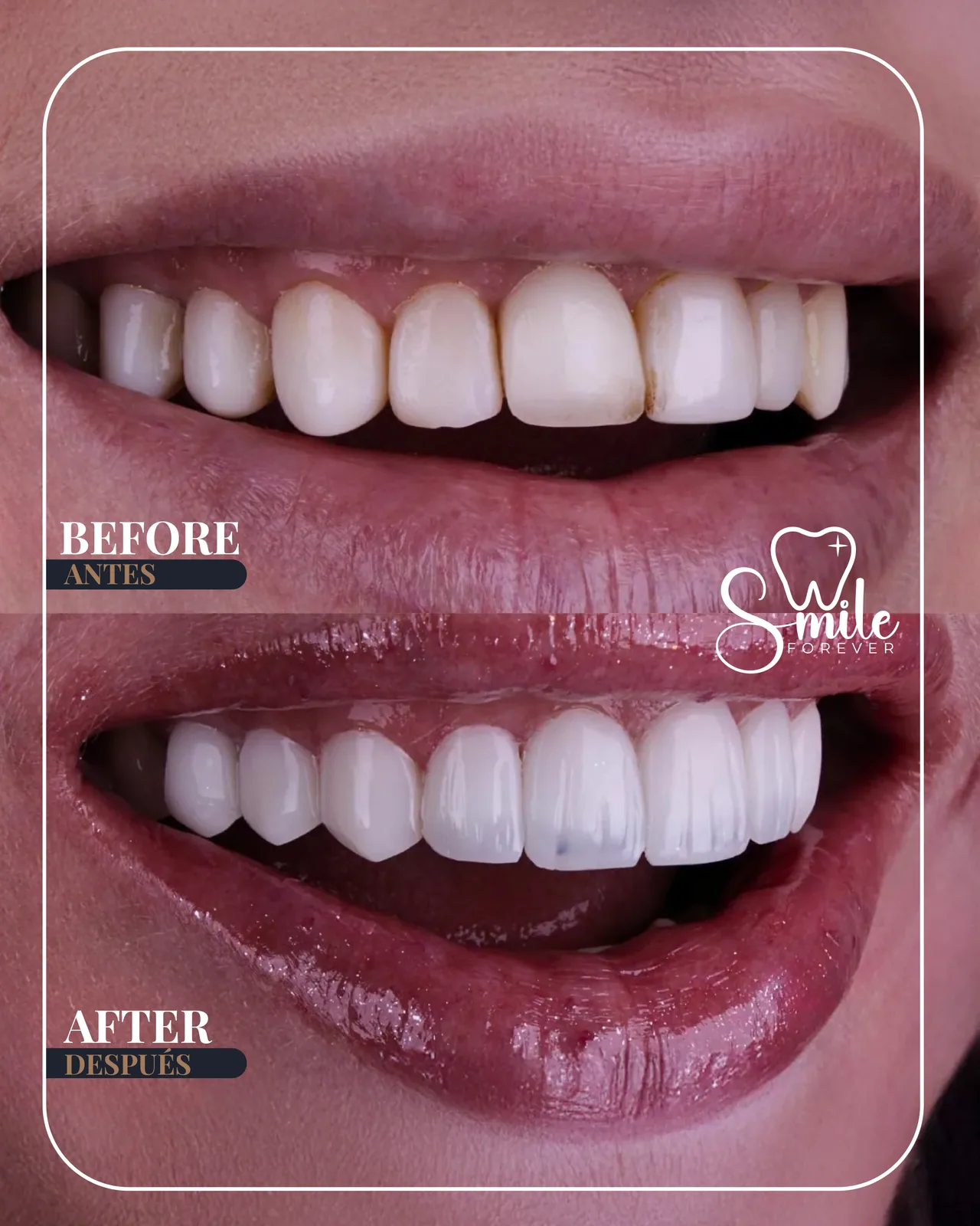 Before and after: feminine smile design with porcelain