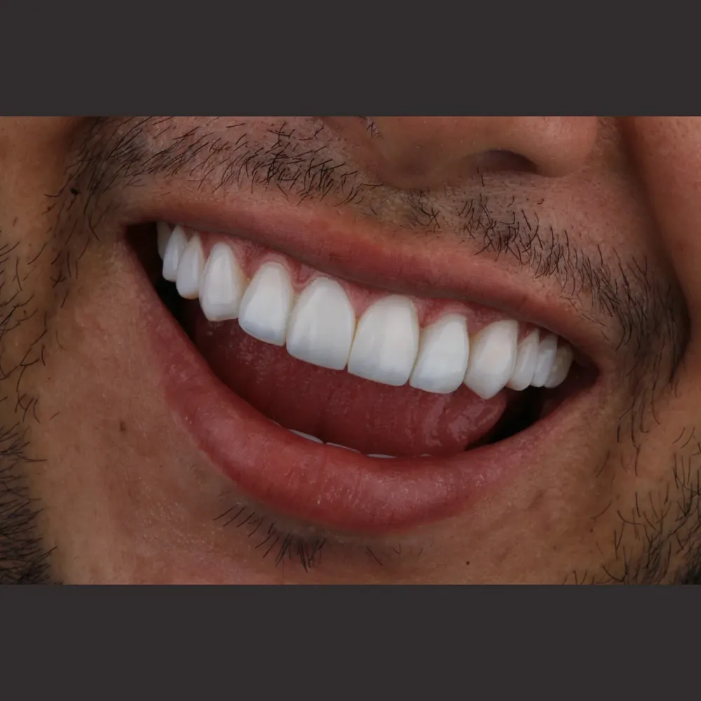 Smile with Smile Forever porcelain veneers