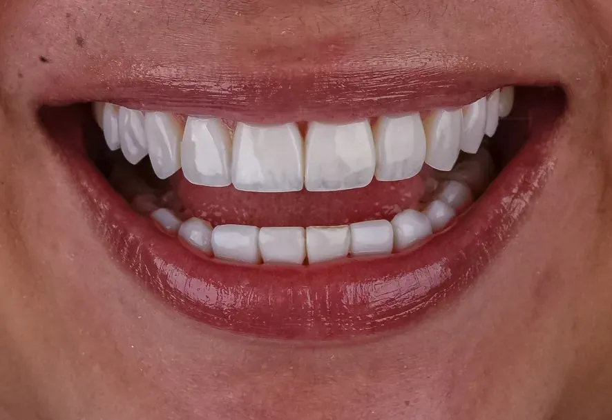 Smile with Smile Forever resin